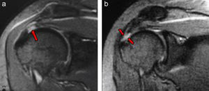 Secuencias T2. Proyección coronal oblicua. Rotura parcial del tendón supraespinoso que afecta a las fibras inferiores (flecha en a). Rotura completa del tendón supraespinoso (flechas en b).