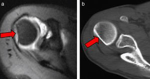 a) Cortes axiales de resonancia magnética. b) Tomografía computarizada del hombro. Fractura de Hill-Sachs (flechas).