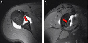 Artrografía mediante resonancia magnética. a) Corte axial del hombro. b) Corte sagital del hombro. Fractura de Bankart (flechas).