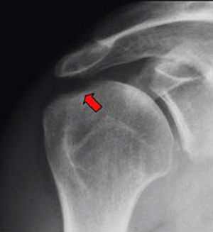Radiografía anteroposterior del hombro. Artritis psoriásica: erosiones óseas (flecha).
