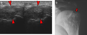Depósito de amiloide. En la ecografía (a) se aprecia una ocupación del espacio articular debido a material hiperecogénico que corresponde a infiltración por material amiloide (cabezas de flecha). La radiografía anteroposterior (b) demuestra erosión ósea (flecha).