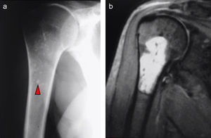 Encondroma. Radiografía anteroposterior (a) en la que se identifican las calcificaciones características de las lesiones condroides (cabeza de flecha). Resonancia magnética de la misma lesión (b).