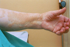 Indurate papule-plaques with brownish hyperpigmentation of the arm.