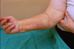 Contracture of the fourth and fifth fingers of the right hand.
