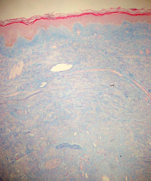 Skin biopsy with preserved epidermis, marked dermal fibrosis and augmented mucin deposits (Alcian blue stain).
