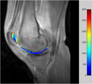 Imagen paramétrica de los valores del tiempo de relajación 1 del cartílago en un equipo de 3 teslas.