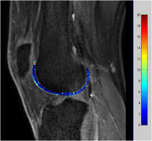 Imagen de los parámetros de farmacocinética de permeabilidad capilar del cartílago en un sujeto normal estudiado con un equipo de 3 teslas.