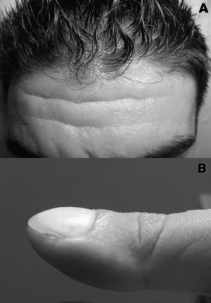 A) Aumento de tamaño de los pliegues frontales asociado a surcos prominentes. B) Dedo en «palillo de tambor» con uñas en «vidrio de reloj».