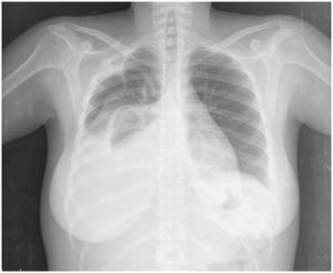 Radiografía de tórax posteroanterior posterior a toracocentesis, que muestra atelectasia y derrame residual.
