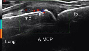 Imagen ecográfica de sinovitis con marcada vascularización sinovial (en color) detectada por power Doppler en una articulación metacarpofalángica sin sinovitis clínica. A: articulación; fp: falange proximal; Long: longitudinal; mc: metacarpiano; MCF: matecarpofalangia.
