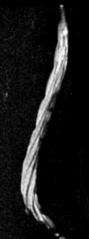 Mielo-resonancia magnética (RM). Imagen sagital en RM con técnica de mielografia delimitando las raíces de la cola de caballo en el saco tecal.