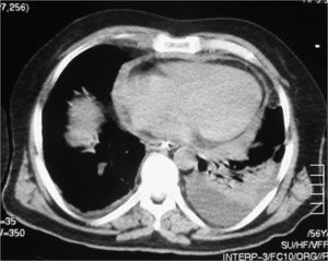 Derrame pericárdico y pleural.