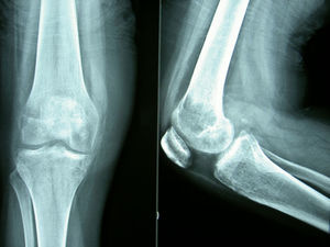 Radiolucencia difusa en metáfisis y epífisis femoral distal sin signos de fractura.