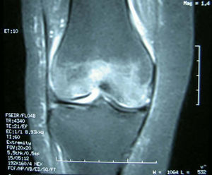 RM en T2: extenso edema óseo a nivel de la epífisis femoral distal, sin alteraciones de la arquitectura ósea.