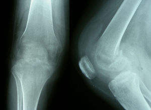 Fractura patológica supracondílea del fémur derecho, apreciándose una intensa radiolucencia femoropatelar y tibial, sin alteraciones significativas en las partes blandas.