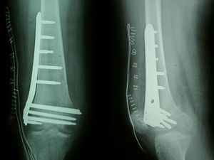 Control radiográfico posquirúrgico tras reducción y osteosíntesis percutánea con placa LISS del fémur distal.