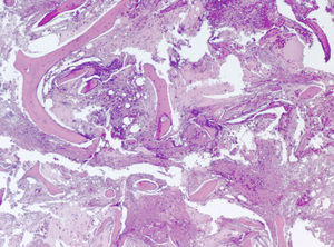 Médula ósea con severo edema, vasodilatación y hemorragia. Tejido fibroso laxo con islotes aislados de tejido adiposo. Ausencia de células hematopoyéticas. Patrón de trabéculas óseas alterado con irregularidad de las mismas y alteración de su disposición.