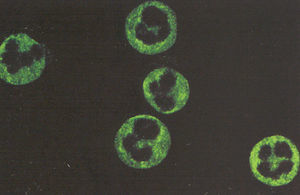 Patrón cANCA. Los anticuerpos que reconocen las proteínas débilmente catiónicas proteinasa-3 (PR-3) y proteína catiónica de 57kDa (CAP-57) dan el patrón citoplásmico en neutrófilos fijados con alcohol o acetona.