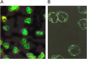 Patrón pANCA. A) Los anticuerpos que reconocen las proteínas fuertemente catiónicas mieloperoxidasa (MPO) elastasa y azuricidina dan el patrón periférico del núcleo en neutrófilos fijados con alcohol o acetona. B) Estos mismos anticuerpos cuando se prueban en neutrófilos fijados con formalina dan un patrón citoplásmico.