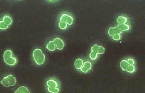 Patrón xANCA o atípico. Los anticuerpos que reconocen las proteínas catepsina G, lisozima y lactoferrina dan el patrón xANCA o atípico en neutrófilos fijados con alcohol, acetona o formalina.