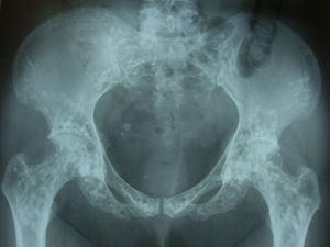 Radiografía simple de pelvis. Múltiples lesiones circulares de radiodensidad aumentada.