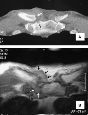 A) Corte coronal de tomografía computarizada de las articulaciones esternoclaviculares del caso 1. En la derecha se observa un aumento del volumen y densidad de las partes blandas, además de erosiones en las superficies óseas articulares (flechas). B) Imagen axial de resonancia magnética ponderada en T2, correspondiente al mismo paciente. Se objetiva destrucción de las superficies articulares y un marcado aumento de partes blandas (flechas) que, posteriormente, dieron paso a un absceso retroesternal que requirió drenaje quirúrgico.
