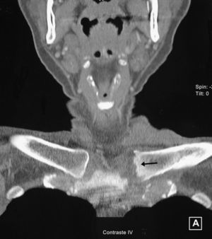 Tomografía computarizada de las articulaciones esternoclaviculares en el caso 2. La izquierda presenta erosiones en su superficie articular (flecha).