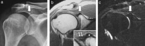 Hombro derecho. a) Radiografía AP de hombro. b) RM con secuencias coronal DP. c) T2 con supresión grasa. Pequeño depósito cálcico adyacente a la glenoides superior (flecha). En la RM se confirma la localización del depósito afectando a la inserción del tendón largo del bíceps en el tubérculo supraglenoideo, con una tenue hiperseñal edematosa en las partes blandas adyacentes de carácter reactivo, visible en la secuencia T2 con supresión grasa (fig. c) y que es habitual en la fase mecánica de la enfermedad. Adicionalmente, puede observarse un derrame por tenosinovitis reactiva en la vaina extraarticular del TLB (asterisco). En la imagen coronal DP (fig. b) puede observarse también un componente de hiperseñal lineal en el labrum superior sospechoso de lesión SLAP que se confirmó en la artroscopia. La lesión SLAP puede verse mejor en la imagen ampliada central de la figura b, como una imagen lineal de orientación lateral dentro del rodete fibrocartilaginoso (flechas blancas), adyacente a la calcificación (asterisco).