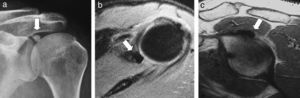 Hombro izquierdo. Radiografía AP de hombro. a) RM con secuencias coronal DP, b) y T2 con saturación grasa, c) Supresión sagital DP. Calcificación ovoidea, más extensa, en idéntica localización a la observada en el hombro derecho, afectando a la zona de inserción ósea del tendón largo del bíceps (flecha). La RM no llegó a identificar la rotura del labrum superior.