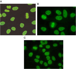 Patrones homogéneos: A) con metafase compacta y tinción de los nucleolos negativa, B) con metafase delineada y tinción de los nucleolos negativa y C) con metafase difusa y tinción de los nucleolos positiva.