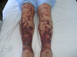 Lesiones purpúricas rojizas, petequiales, confluentes y tendentes al desarrollo de flictenas o úlceras.
