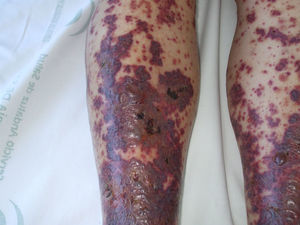 Areas extensas de confluencia, flictenas y algunas ulceraciones por pérdida de la epidermis.