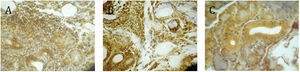 Inmunohistoquímica para factor NF-κB en glándulas salivares menores. A) Paciente del grupo A: se observa translocación nuclear en epitelio acinar y en células linfoplasmocitarias que forman los focos confluentes inflamatorios. B) Paciente grupo B, con sialoadenitis: translocación nuclear en componente inflamatorio intersticial y en el citoplasma del epitelio acinar y ductal. C) Paciente del grupo C: positividad citoplasmática en el epitelio acinar y ductal. (aumento 40×).