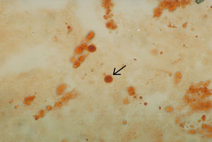 Cristales de hidroxiapatita de calcio teñidos con rojo alizarina. La fotografía muestra un cúmulo rojo de forma redonda y centro de color más intenso. Preparación observada en microscopio de luz visible 400×.