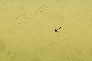 La fotografía muestra un cristal de Charcot-Leyden compuesto de fosfolipasa B, tiene forma de puro y birrefringencia positiva. Muestra observada en microscopio de luz visible 400×.