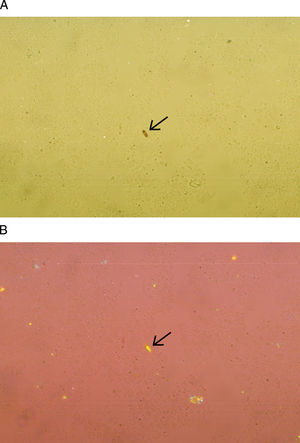 La fotografía muestra cristales de hematoidina, en la que se observa su forma rectangular. Con el microscopio de luz visible se observan de color café u oro 400× (A), en tanto que con el microscopio de luz polarizada se pueden observar con birrefringencia positiva o negativa 400× (B).