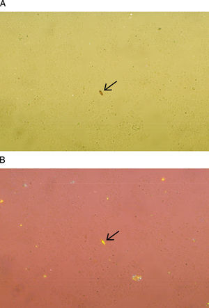 La fotografía muestra cristales de hematoidina, en la que se observa su forma rectangular. Con el microscopio de luz visible se observan de color café u oro 400× (A), en tanto que con el microscopio de luz polarizada se pueden observar con birrefringencia positiva o negativa 400× (B).