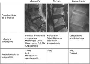 Correlación entre los hallazgos de imagen, características anatomopatológicas y potenciales dianas terapéuticas en las distintas fases evolutivas de la lesión primordial en la EA. En una primera fase inflamatoria, caracterizada por lesiones brillantes en las secuencias STIR y T1 posgadolinio, se produce un intenso infiltrado del hueso subcondral por linfocitos T CD3+ CD8+, osteoclastos, y neoangiogénesis. En esta primera fase, la dianas terapéuticas serían el TNFα, la interleucina-6, los linfocitos T, los macrófagos y osteoclastos CD68+ y los factores humorales implicados en la angiogénesis, como el factor de crecimiento de endotelio vascular. En una segunda fase de fibrosis, caracterizada en las secuencias T1 como áreas grises, se produce fibrosis reparativa, con presencia de fibroblastos; en esta fase, la diana molecular fundamental sería el transforming grow factor-α. En una tercera fase, se produciría la aposición ósea con aparición de osteoblastos en el foco reparativo. En esta última fase la dianas biológicas serían las proteínas de la matriz ósea y la vía proosteoblastogénica Wnt.