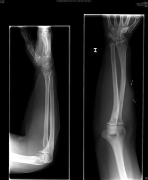 Rx antebrazo izq: Evidencia una masa de densidad de partes blandas sin signos de erosión del hueso subyacente.