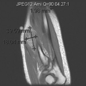 RM corte coronal secuencia T1 con contraste antebrazo izq: Se observa una masa sólida de morfología ovalada, de aproximadamente 39×18mm, predominantemente hiperintensa, con realce irregular de la masa y del área de edema adyacente.
