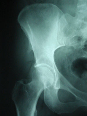 Rx de pelvis realizada 2 años después de la biopsia ósea, que muestra la existencia de una exostosis (flecha).