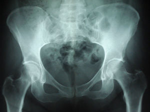 Rx de pelvis sin alteraciones destacables, realizada antes del trasplante hepático.