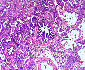 Biopsia de pulmón: coloración hematoxilina-eosina. A) Bronquiolos. B1) Espacios alveolares enfisematosos. B2) Alvéolos colapsados. C) Tabiques fibrosos interalveolares. D) Arteriola. E) Hiperplasia muscular.