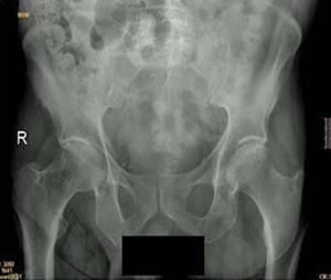 En la radiografía de pelvis inicial se observa estrechamiento del espacio articular y esclerosis subcondral.