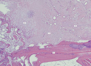 Areas de tejio óseo ileso (A), tejido óseo necrotico (B) y tejido cartilaginoso (C).