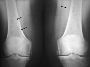 Radiografía simple de rodillas que muestra las lesiones líticas sin bordes esclerosos de distintos tamaños sin destrucción cortical en ambos fémures.
