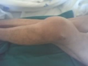 Fotografía de la rodilla izquierda, en la cual se aprecia gran aumento de volumen.