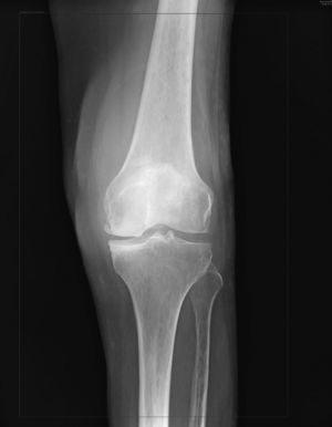 Radiografía en proyección anteroposterior de la rodilla izquierda, en la cual se aprecia aumento de volumen en los tejidos blandos.