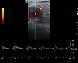 Corte transversal Doppler color.