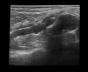 Modo Logiqview (visión panorámica): aneurisma poplíteo y aneurisma femoral.